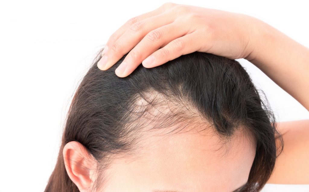 scalppigmentatie-alopecia-PMUTina