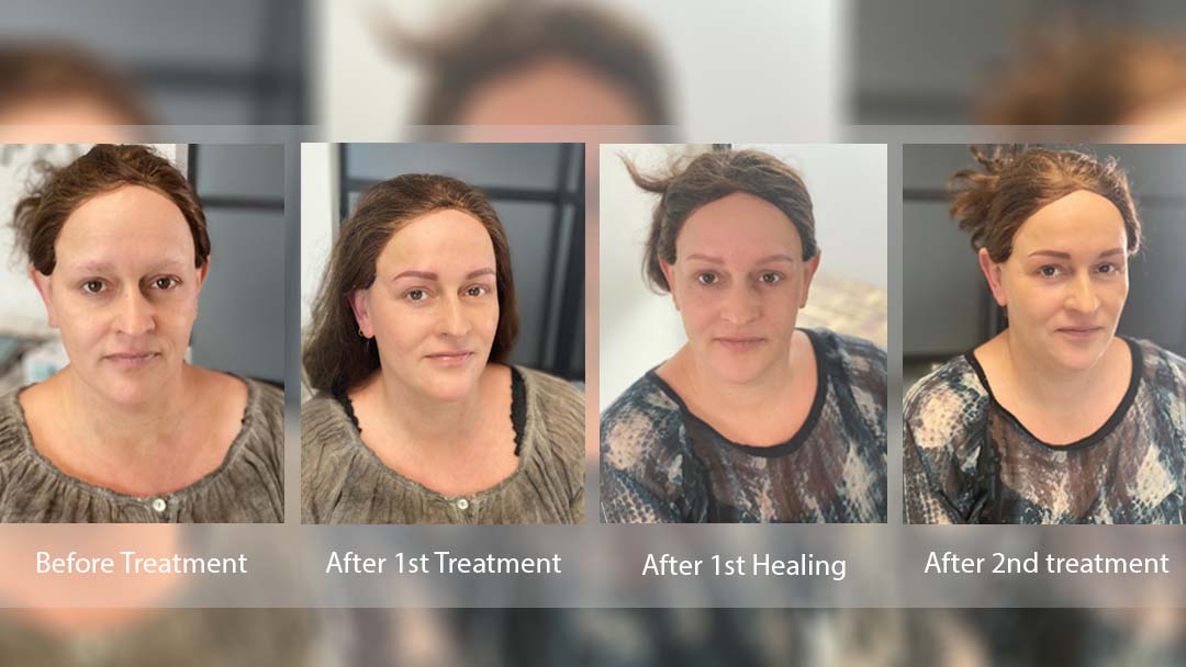 after-pmu-genezing-pmut-tina